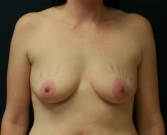 Feel Beautiful - Breast Augmentation San Diego Case 49 - Before Photo
